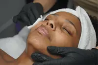 Peeling behandeling bij MartensSkin